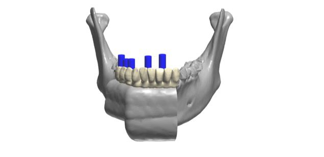 jaw guides